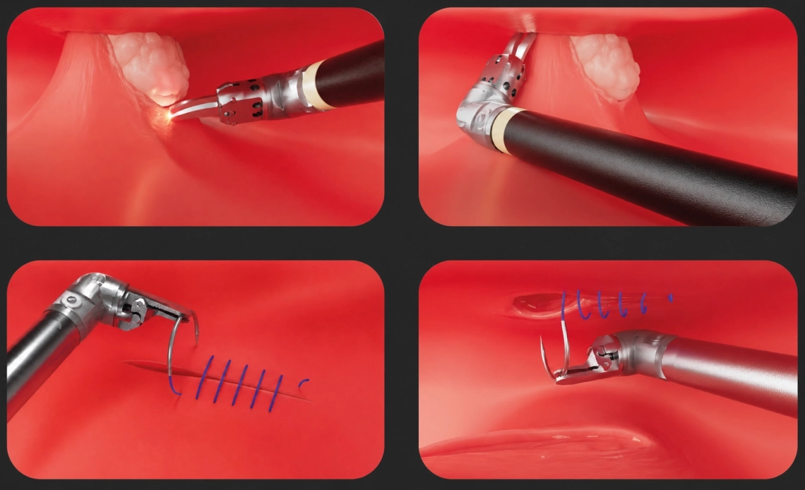 DEX dissection and suturing